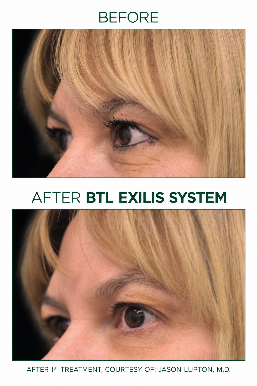 BTL Exilis eye-area before-and-after comparison; courtesy credit shown in the image