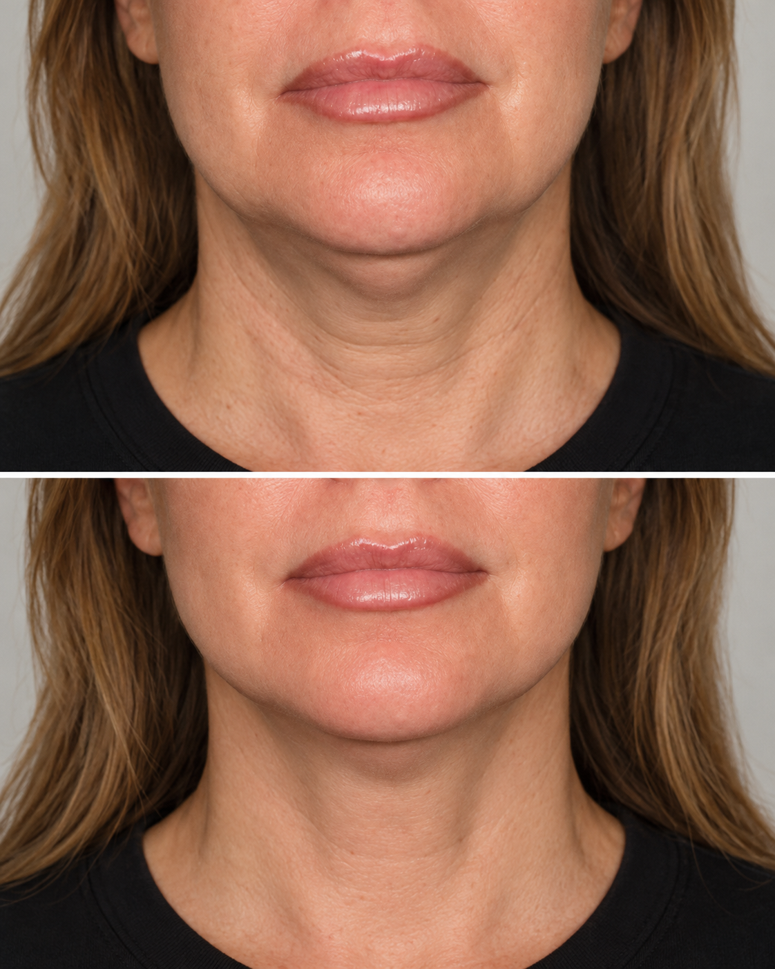 Face and neck comparison image supplied for the BTL Exilis page