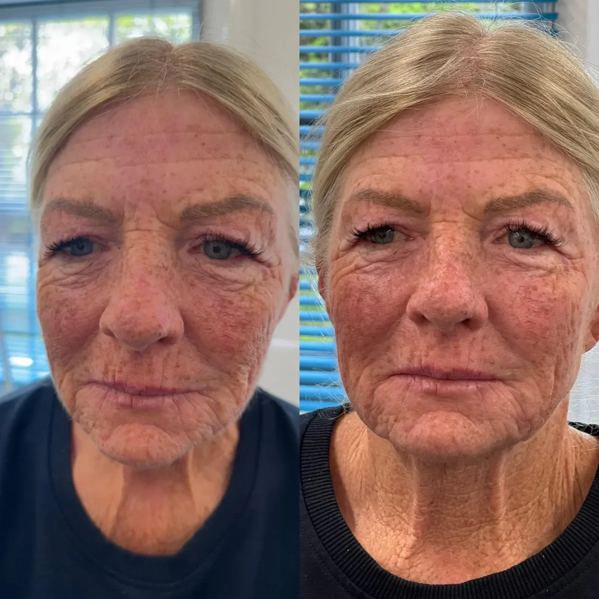 Facial volume and contour illustration