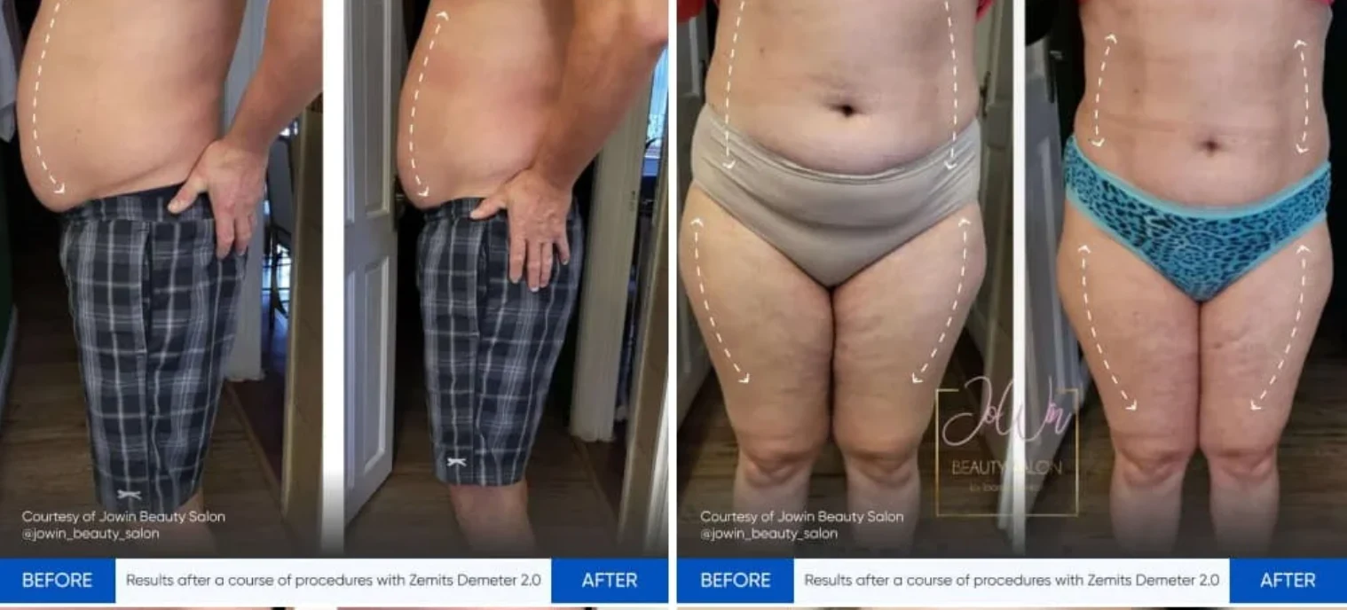 Lymphatic Drainage Pressotherapy treatment image
