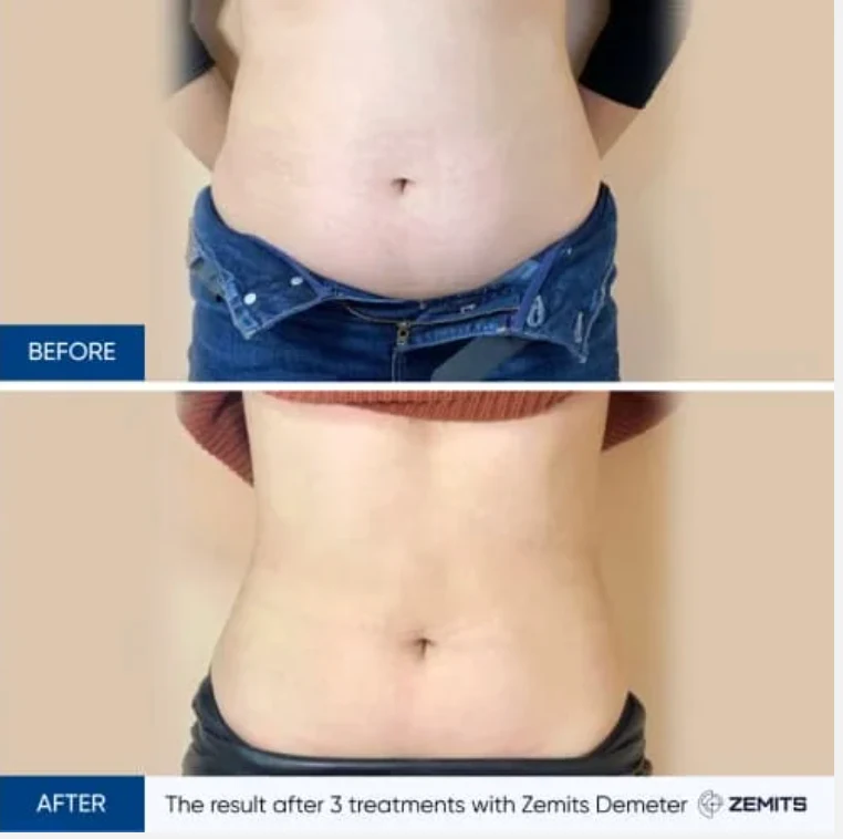 Advanced Lymphatic Drainage Pressotherapy treatment gallery image 1