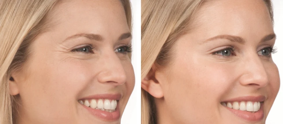 Lines and Wrinkles Consultation treatment image