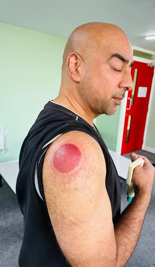 Cupping Treatment treatment image