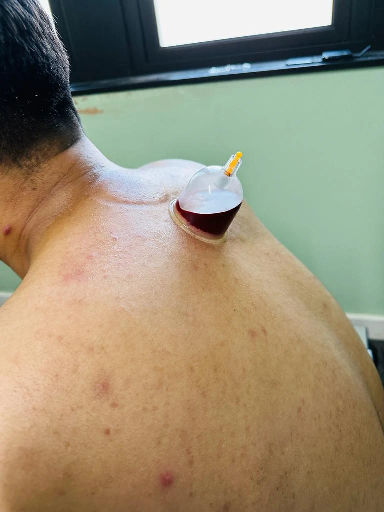 Cupping Treatment treatment image