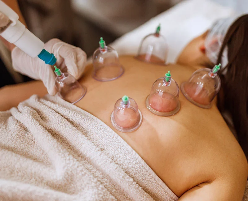 Cupping Treatment treatment gallery image 1
