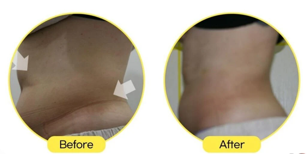 Fat-Dissolving Injection Consultation treatment image