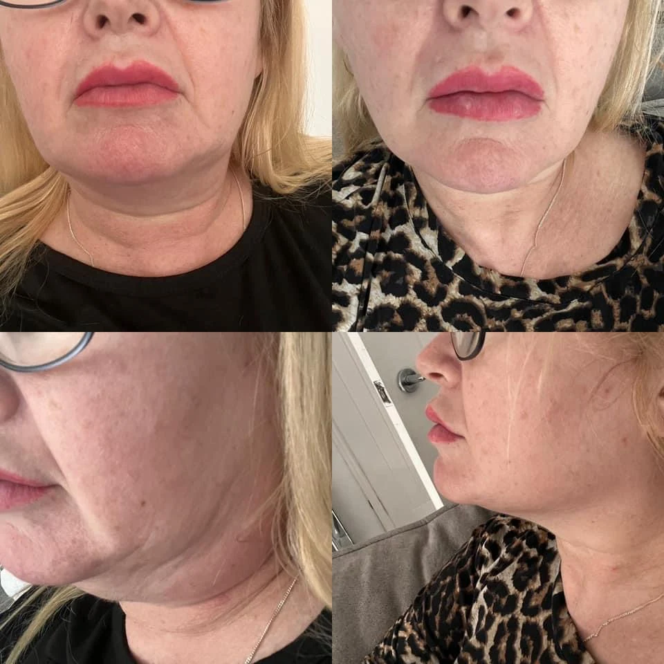 Chin and under-chin contour illustration
