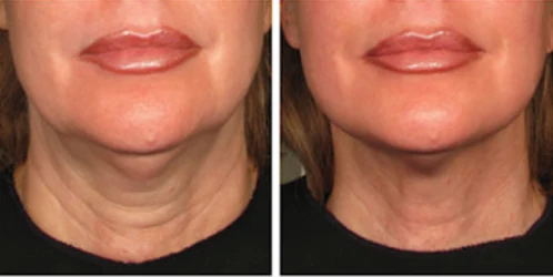 HIFU face and neck illustration