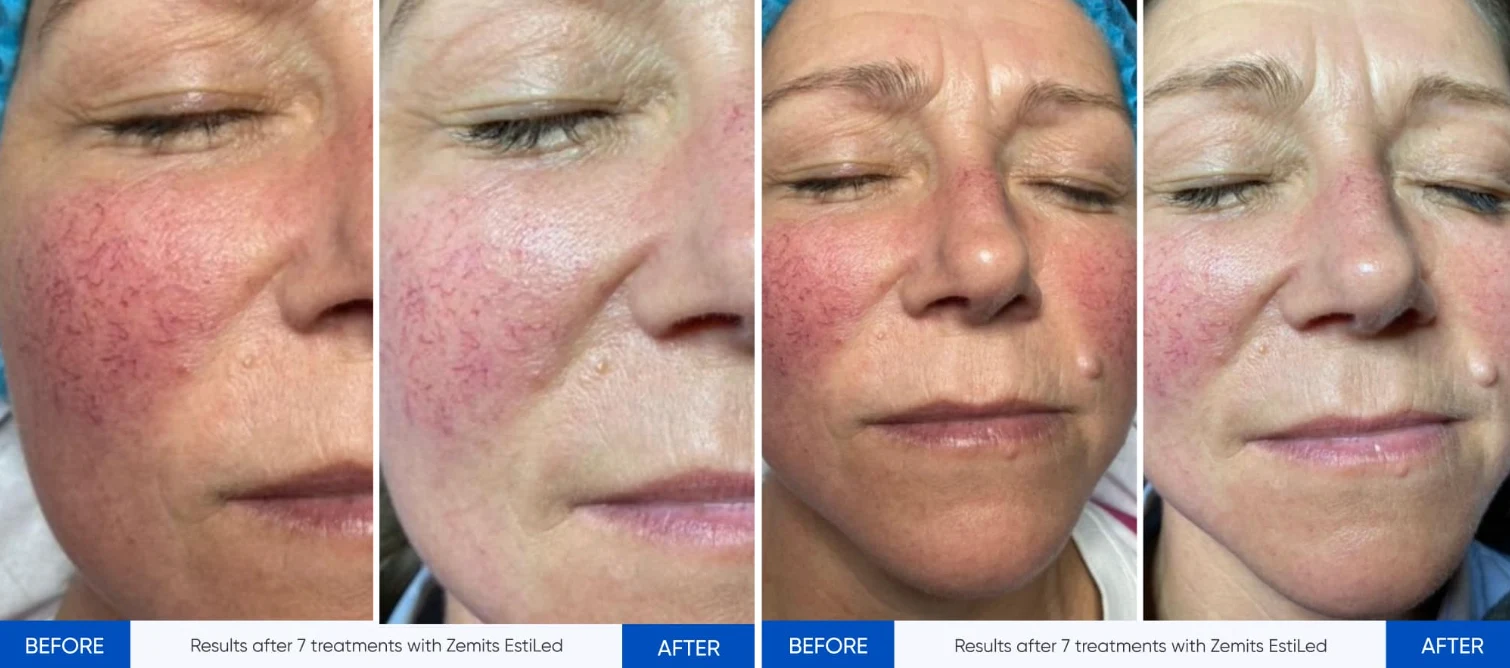 LED Light Therapy Facial treatment image