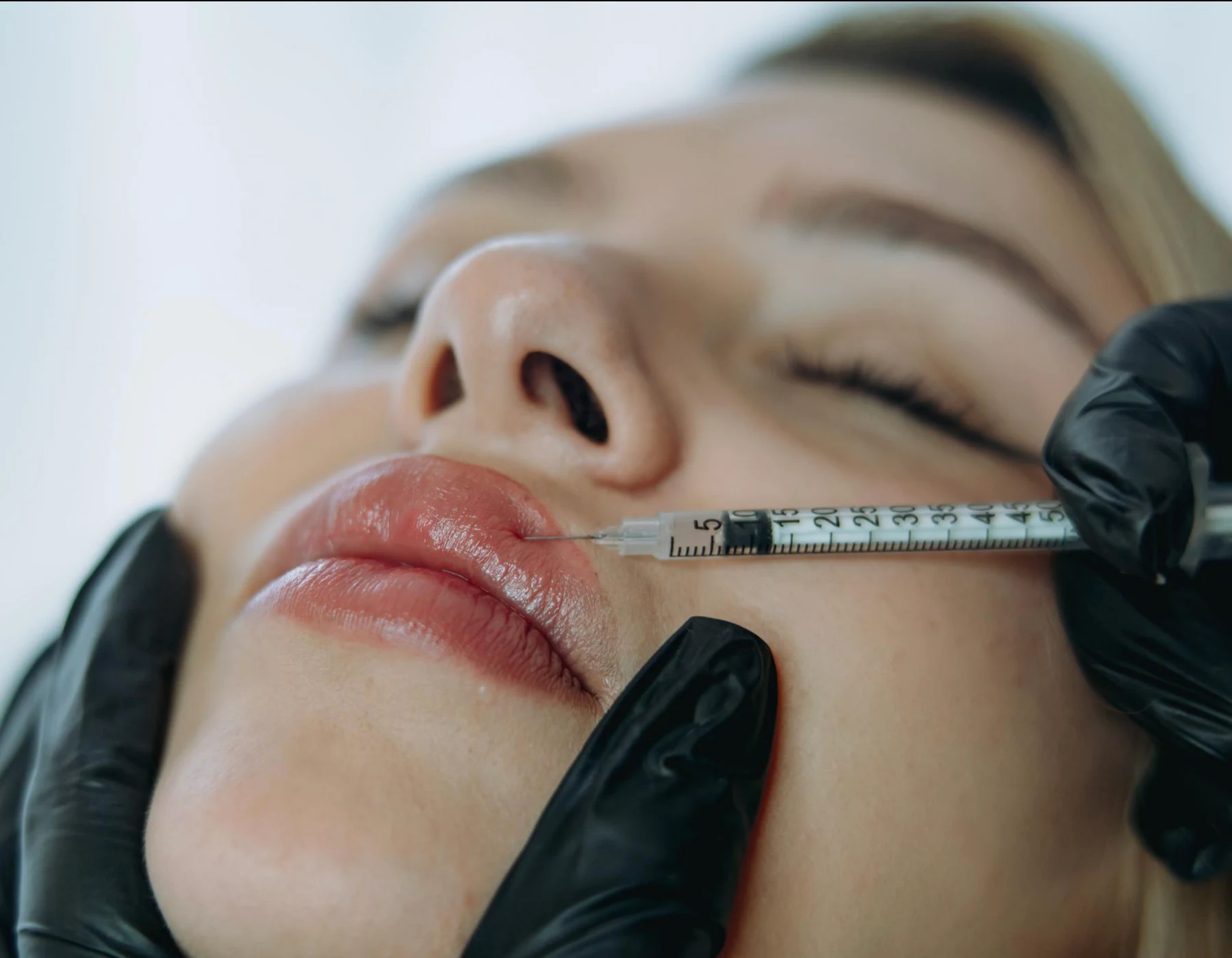 Injectable lip treatment photograph