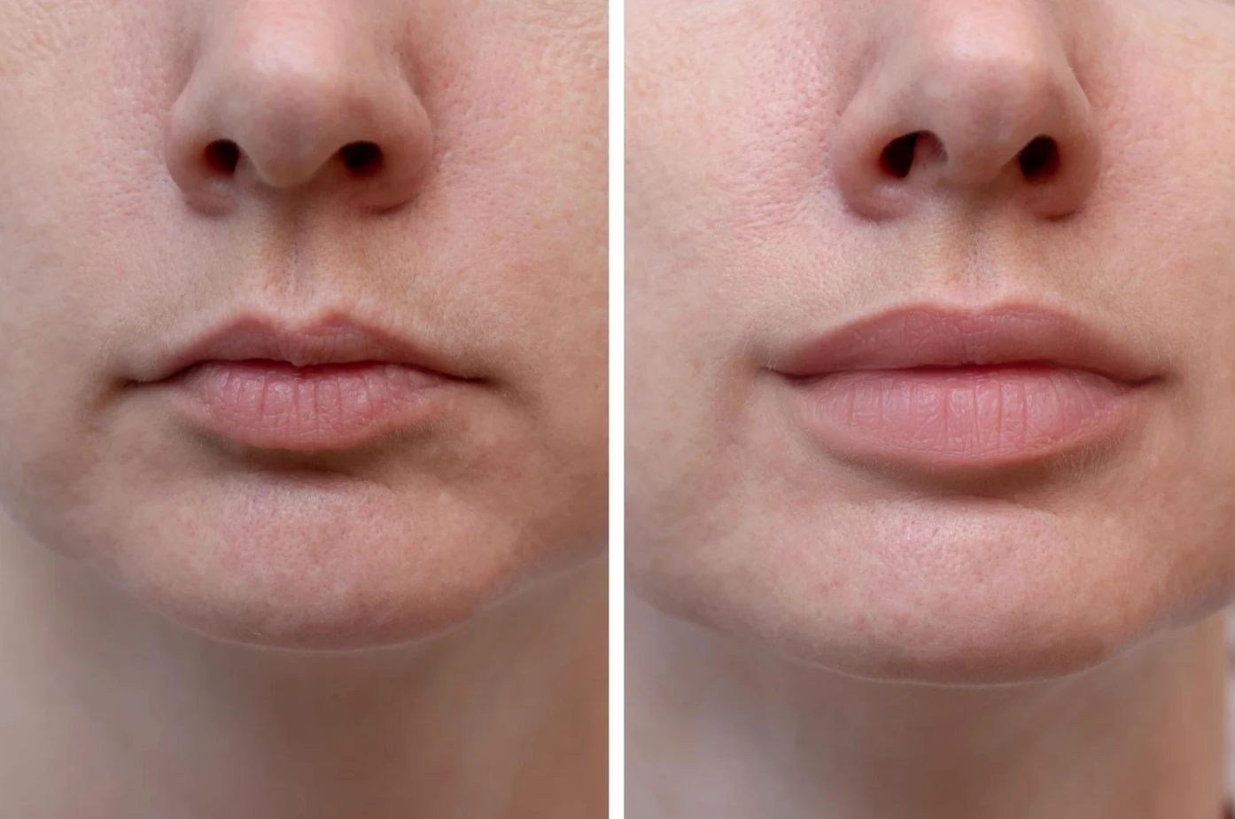 Lip Fillers treatment image