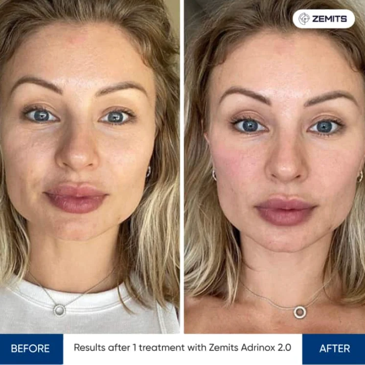 Microcurrent Facial treatment image