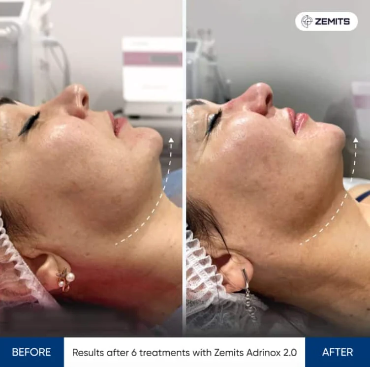 Microcurrent Facial treatment image