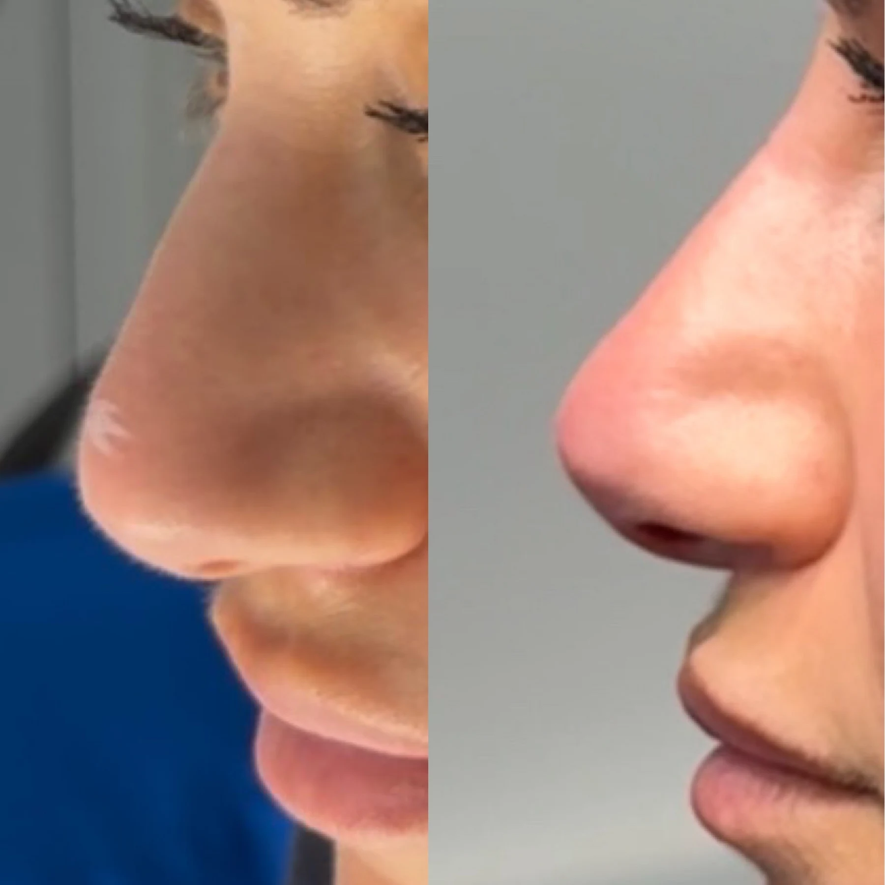 Non-Surgical Liquid Rhinoplasty treatment image