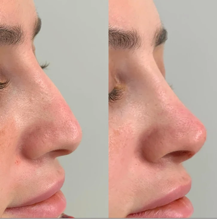 Non-Surgical Liquid Rhinoplasty treatment image