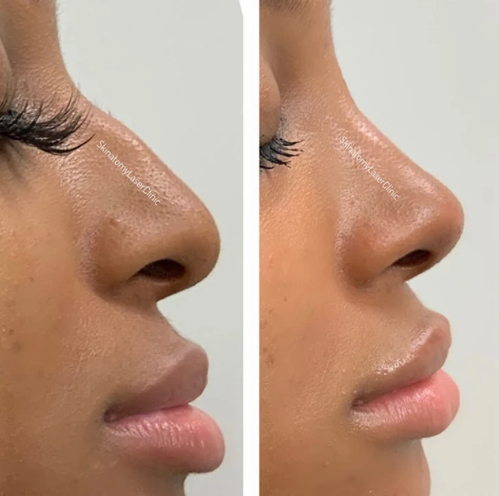 Non-Surgical Liquid Rhinoplasty treatment image