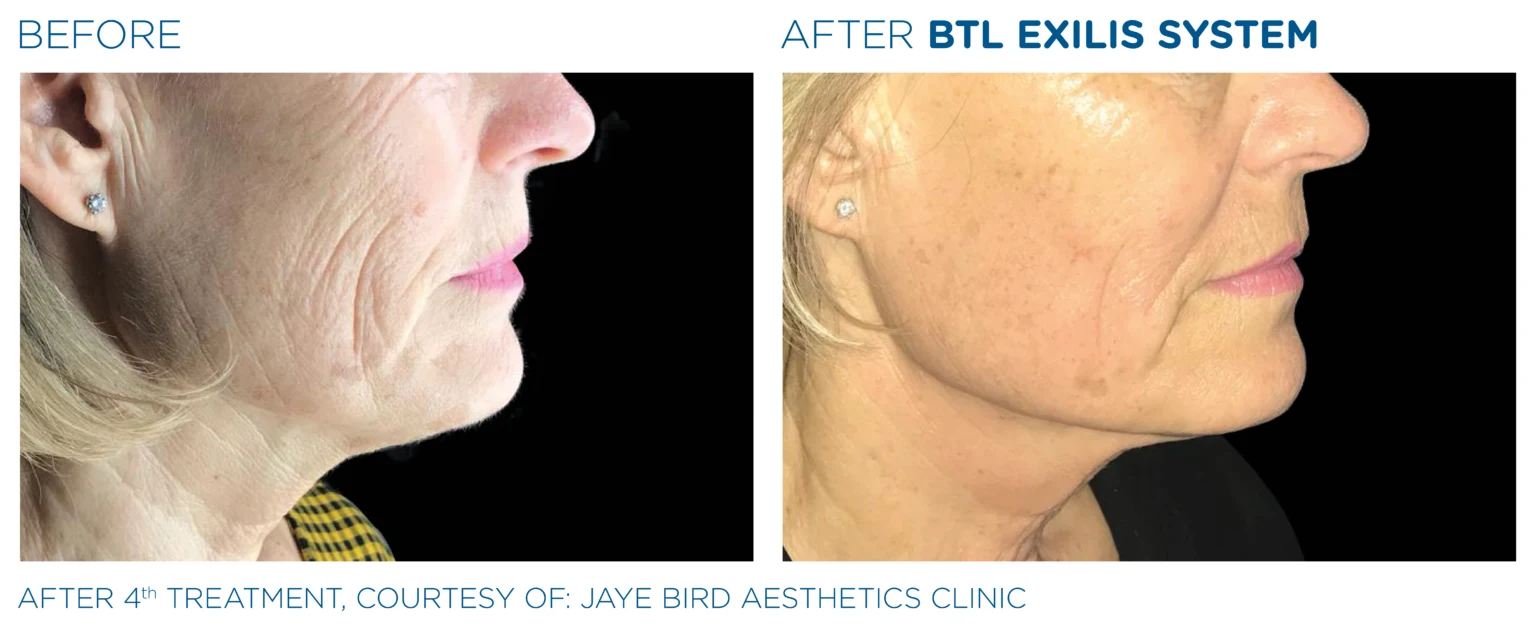 BTL Exilis facial comparison image