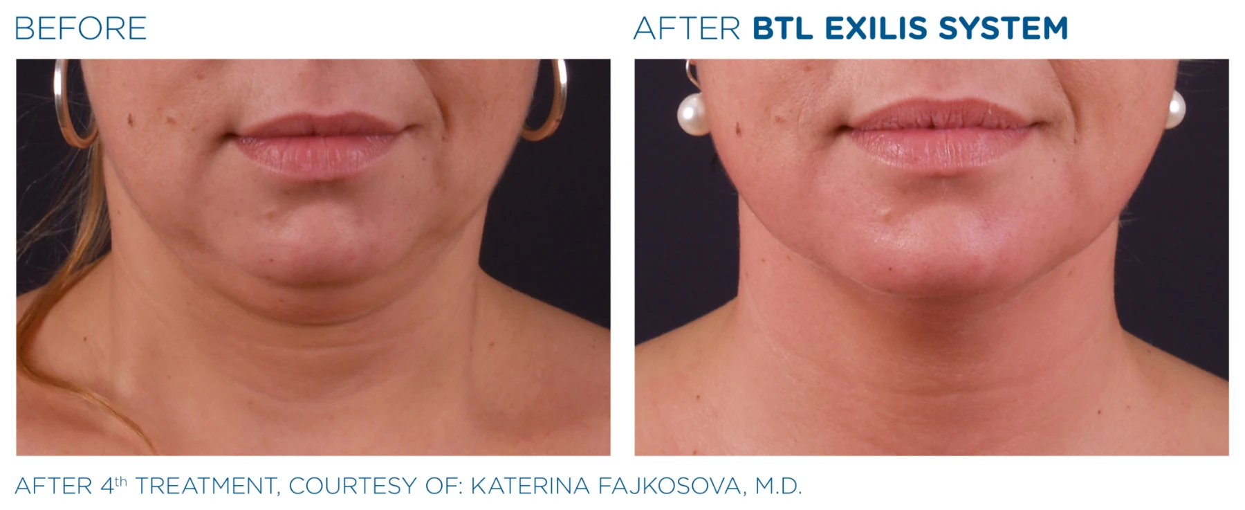 Lower-face and jawline skin illustration