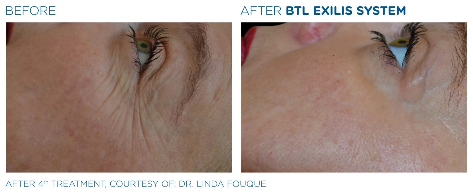Fine lines around the eye area