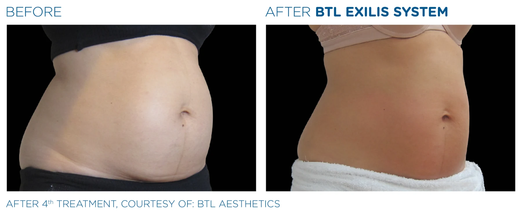 BTL Exilis Body Tightening treatment image