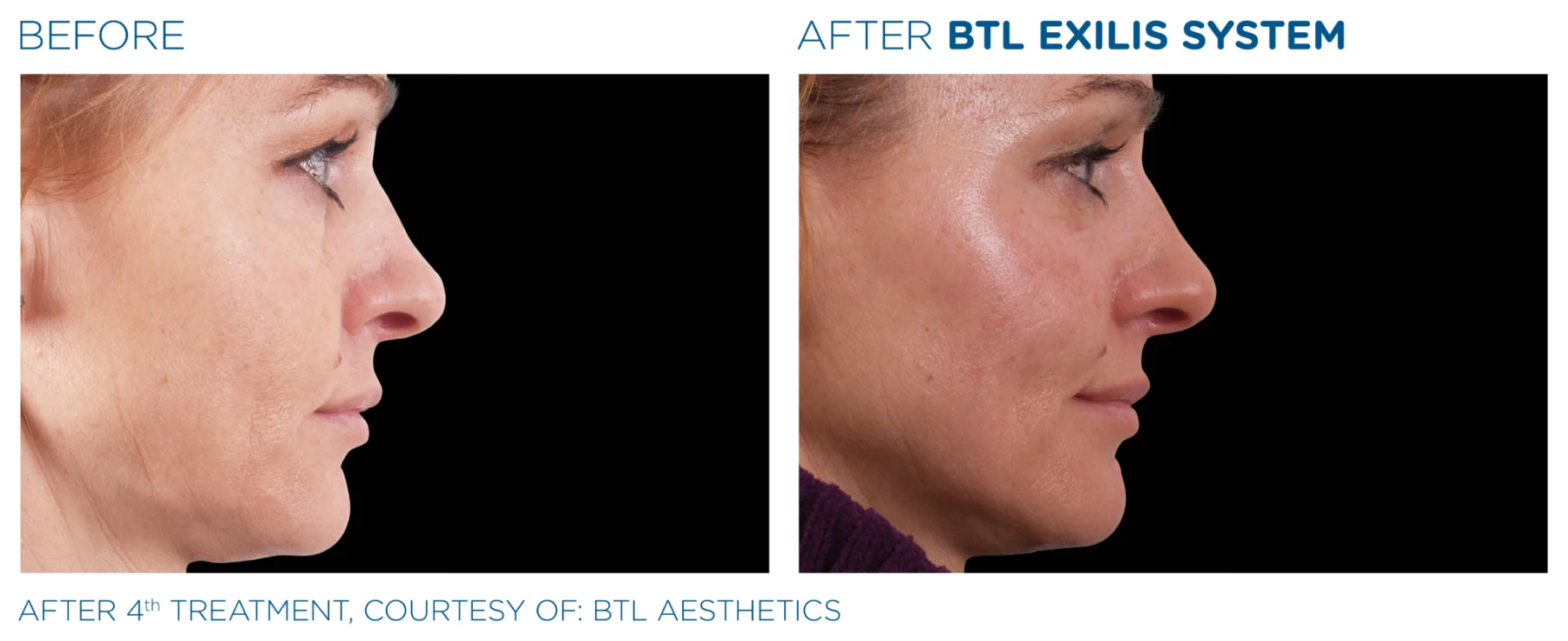BTL Exilis face-treatment illustration