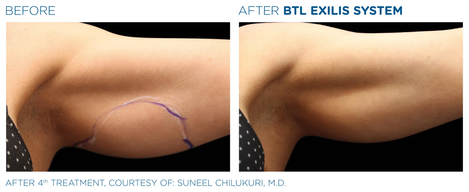 Upper-arm skin-laxity illustration