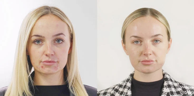 Skin Boosters treatment image
