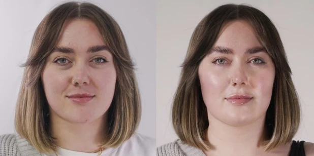 Skin Boosters treatment image