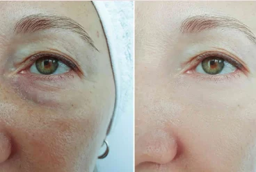 Under-eye skin illustration