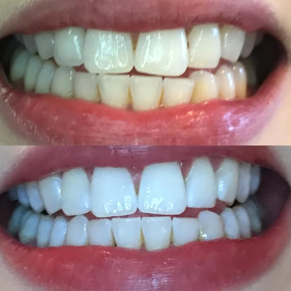 Teeth Whitening treatment gallery image 1